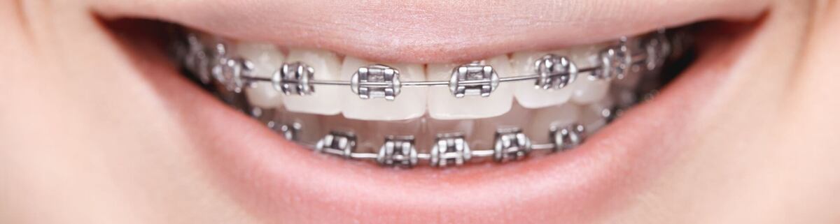 Close-up of smile with braces